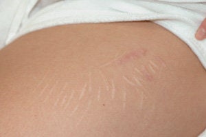 Laser resurfacing for cutting scars before 199407