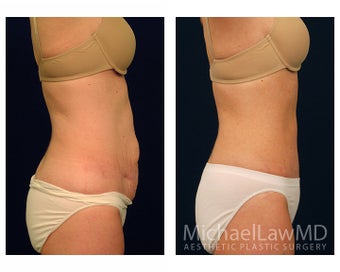 Abdominoplasty - Tummy Tuck 396132