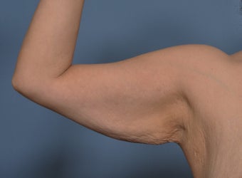 Arm Lift 530722