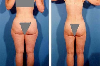 Liposuction before 636105