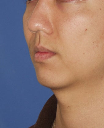 Chin Implant before 414146