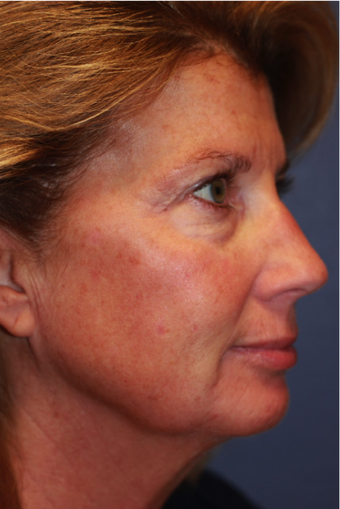 Laser Resurfacing before 408894
