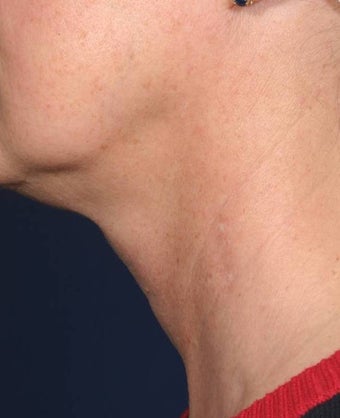 Fraxel - neck before 136747