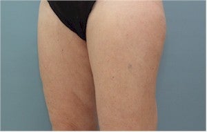 Smartlipo after 607207