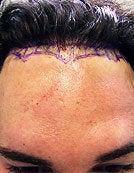 FUE – BHT Using Only Body (Leg) Hair to repair Hair Line before 196031