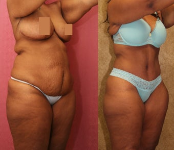 tummy tuck after 304705