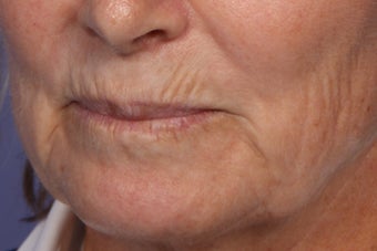 Botox and Juvederm 309243