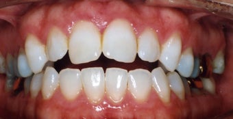 Orthodontic braces with miniscrew support to close openbite before 404689