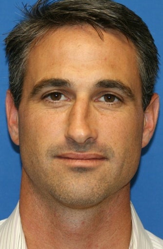 Rhinoplasty before 223229