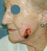 Mohs skin cancer surgery with reconstruction on the cheek before 84501