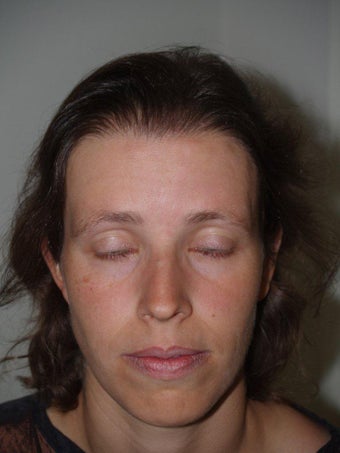 Hair Transplant / Hairline Advancement after 230329