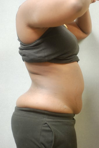 Upper and lower Abdomen & Flanks 346579