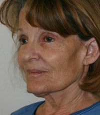 blepharoplasty (eyelids) before 219346