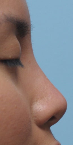 Non Surgical Rhinoplasty after 307850