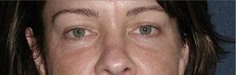 Restylane before 596241