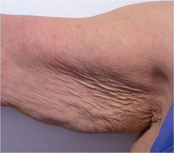 Accent for Cellulite Treatment before 600365