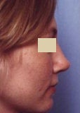 Rhinoplasty revision after 130776
