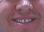 Porcelain Veneers before 109168