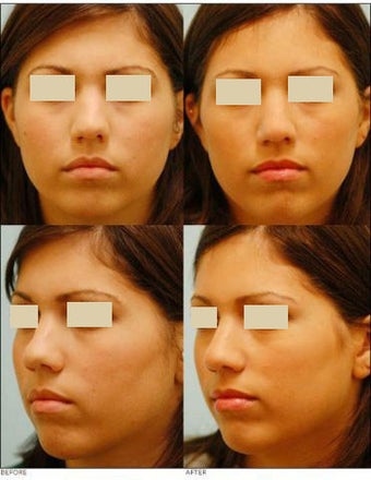 Revision/Corrective Rhinoplasty before 136567