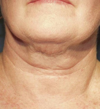 Thermage before 135923