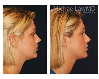 Chin Liposuction 395411