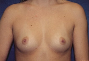Breast Augmentation before 266923
