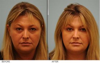 Restylane and Short Term Botox before 379785