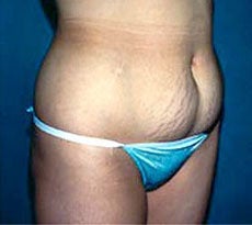 Smartlipo 401651