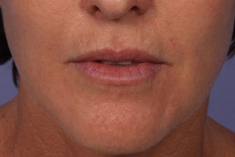 Botox and Juvederm Ultra Plus to Upper Lip after 308354