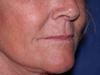 Juvederm to corners of the mouth and Botox to DAO after 100156