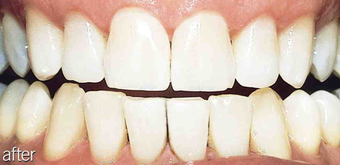 Whitening aging teeth after 234632