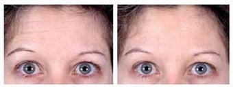 Botox for Forehead Wrinkles before 6320