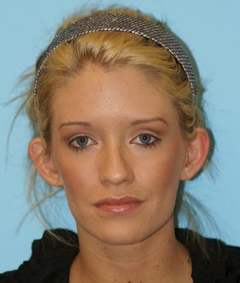 Otoplasty before 574622