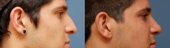 Rhinoplasty, Ethnic Iranian before 346238