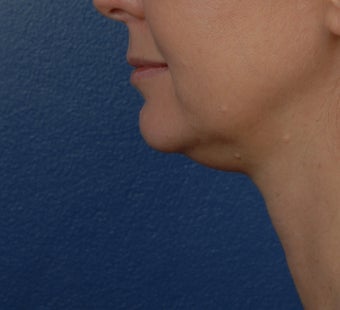 Ulthera before 531589