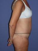 Body Lift 329945