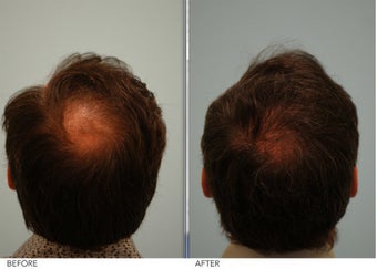 Crown (vertex) Hair Restoration before 396052