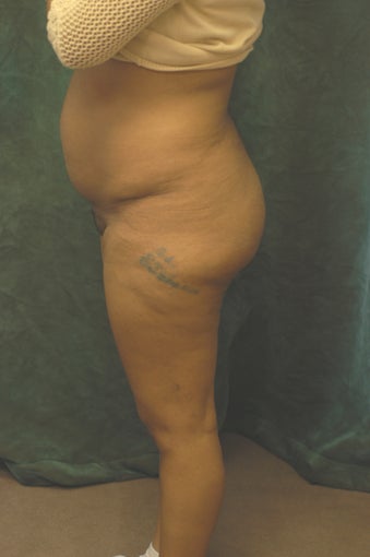Women's Buttocks Augmentation after 518137