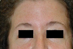 Botox for forehead lines after 93347