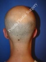 Ear Surgery (Otoplasty) 579096