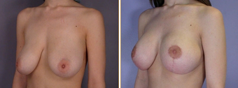 Mastopexy, Breast Lift before 270056