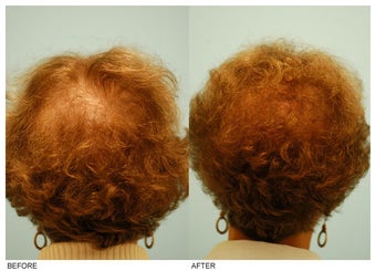 Crown (Vertex) Hair Transplant before 134774
