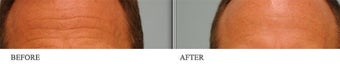 Botox (Longterm) before 436488