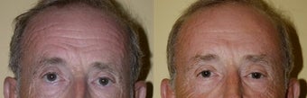 BrowLift before 314265