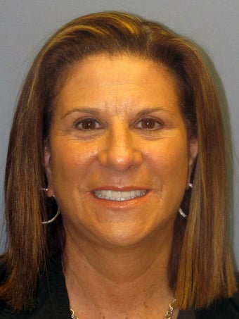 Neck Lift, Platysmalasty after 634751