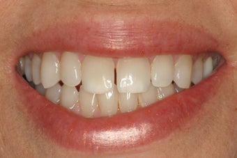 KOR Whitening before 370142