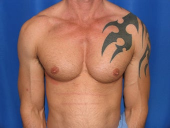 Pec Implants after 420119