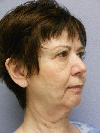 Lower Face Neck Lift before 574541