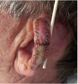 Skin Cancer Surgery on Ear 561007