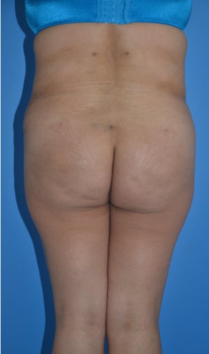 Liposuction and Abdominoplasty after 555508